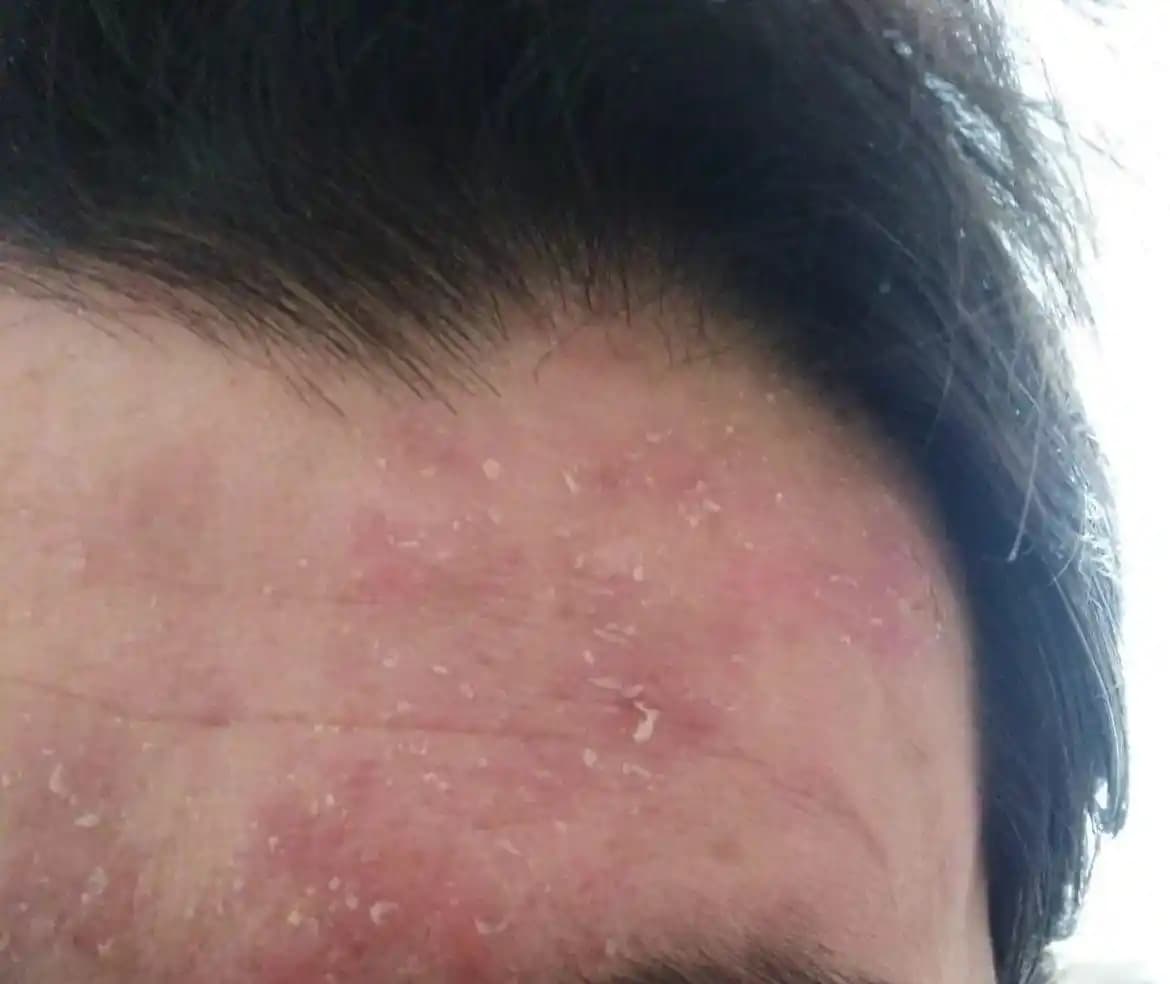 Seboreik Egzema ve Kozmetik Ürün Seçimi: Cilt Bakımında Dikkat Edilmesi Gerekenler