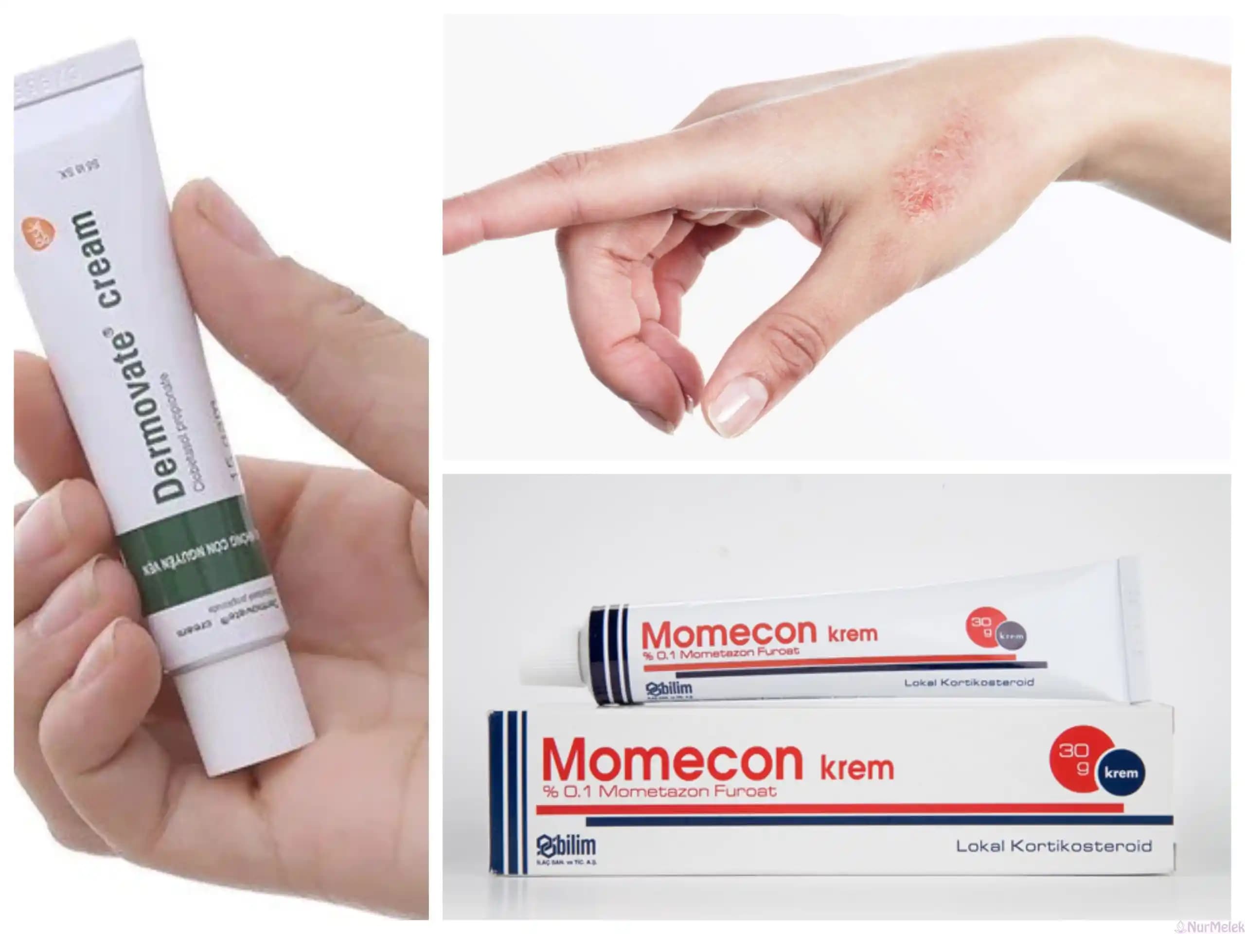 Sedef Hastalığına İyi Gelen Krem Türleri ve Cilt Sağlığını Destekleyen Yaklaşımlar