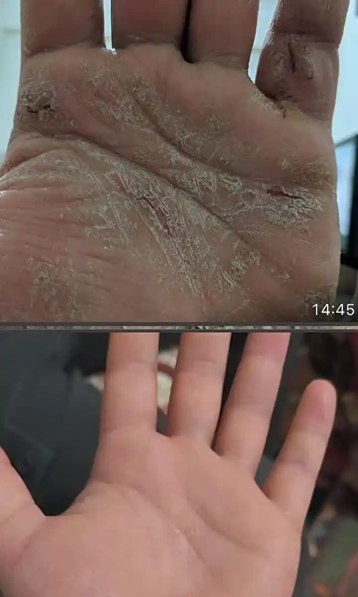 Sedef Hastalığına Karşı Etkili Güzellik ve Sağlık Yaklaşımları