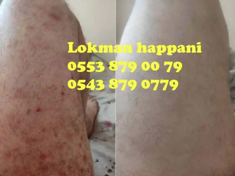 Sedef Hastalığında Doğal Çözümler ve Gavur Pancar Kremi Kullanımı