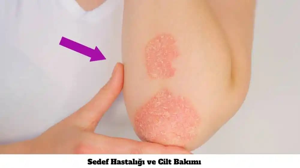 Sedef Hastalığında Doğru Beslenme ve Cilt Sağlığını Destekleyen Diyet Yaklaşımları