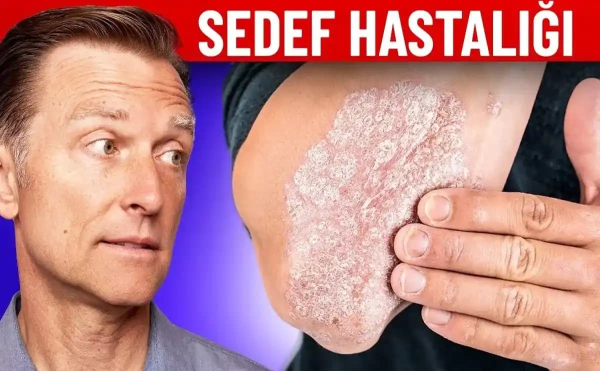 Sedef Hastalığında Doğru Dermatolog Seçimi ve Etkili Cilt Bakım Yöntemleri