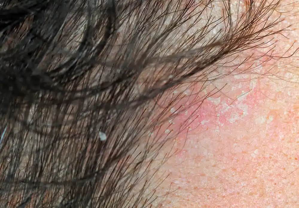 Sedef Hastalığının Saç Dökülmesine Etkisi ve Korunma Yolları