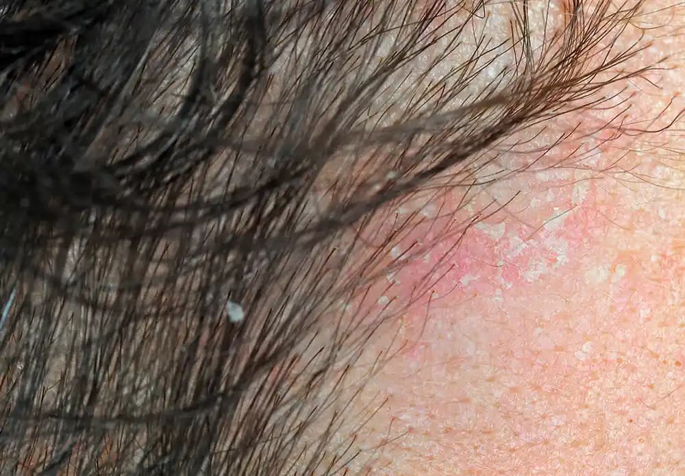 Sedef Hastalığının Saç Dökülmesine Etkisi ve Korunma Yolları