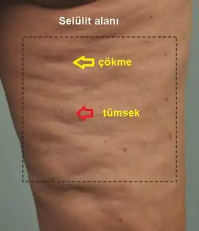 Selülit Nedir, Nasıl Azaltılır ve Cilt Sağlığını Koruma Yolları