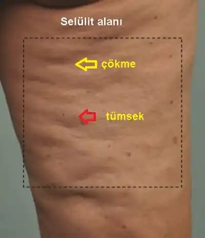 Selülit Nedir, Nasıl Azaltılır ve Cilt Sağlığını Koruma Yolları