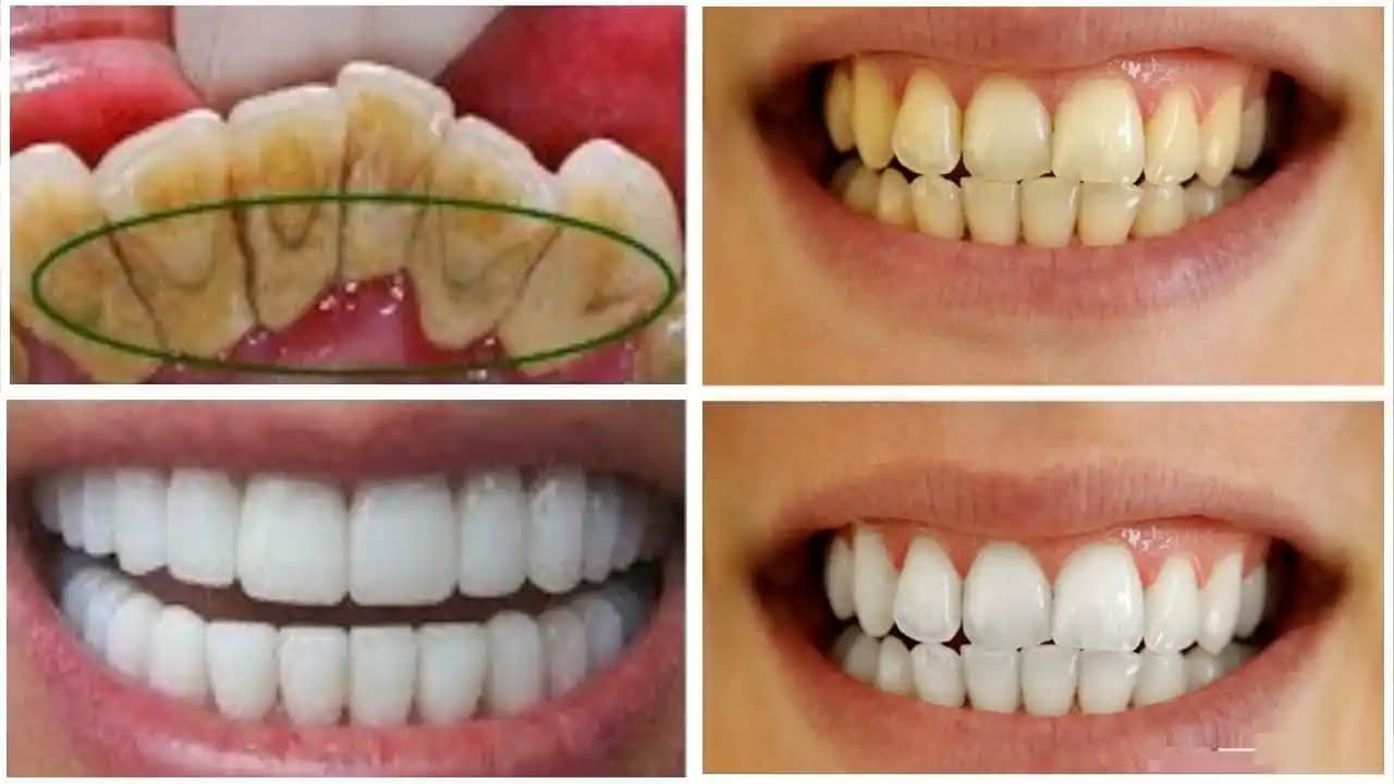 Sigara Lekeleriyle Mücadele: Güzel ve Sağlıklı Dişler İçin Bilmeniz Gerekenler