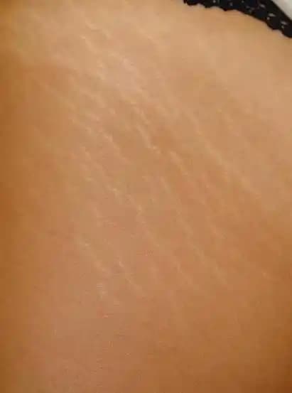 Sırt Çatlakları Nedenleri, Tedavi Yöntemleri ve Önleme İpuçları