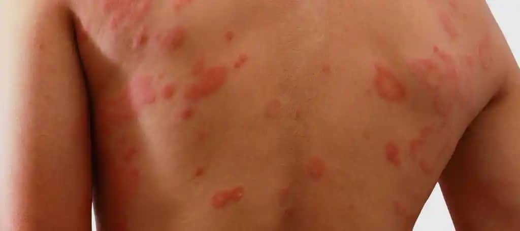 Sırt Egzaması Nedir ve Kozmetik Bakım İpuçlarıyla Yönetimi Nasıl Yapılır