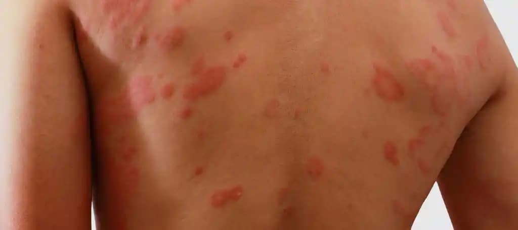 Sırt Egzaması Nedir ve Kozmetik Bakım İpuçlarıyla Yönetimi Nasıl Yapılır