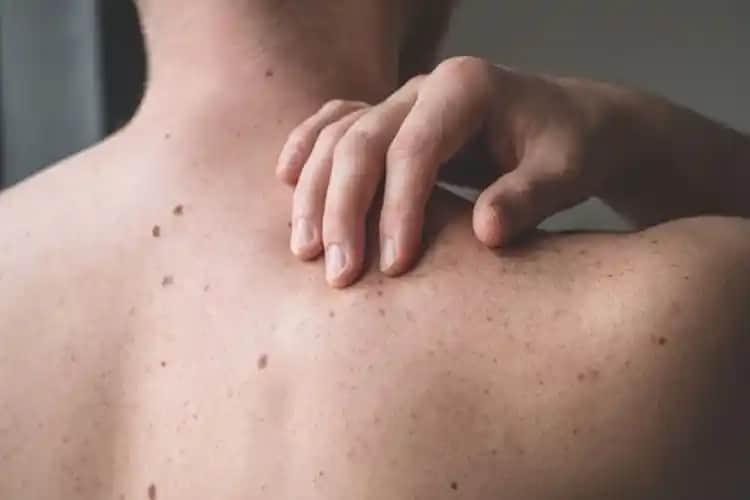 Sırt Lekeleri Nedenleri ve Korunma Yöntemleri Cilt Sağlığını Geliştiren Bilgiler