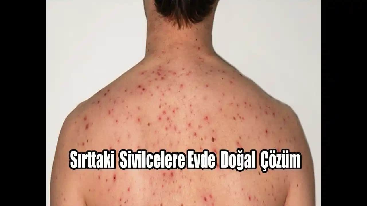 Sırt Sivilcelerine Karşı Etkili Çözüm Yöntemleri ve Cilt Sağlığı Rehberi