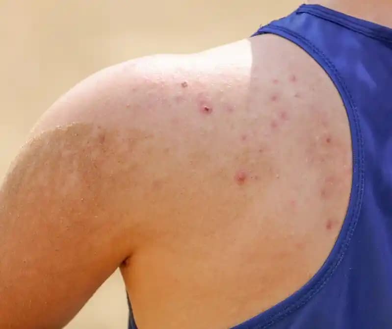 Sırtta Akne Nedenleri ve Etkili Tedavi Yöntemleri Hakkında Kapsamlı Bilgi