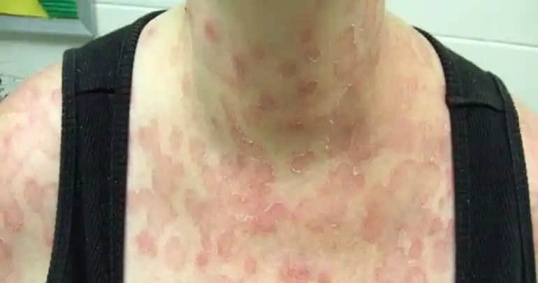 Sırtta Gül Hastalığı ve Kozmetik Bakımda Etkili Çözüm Yolları