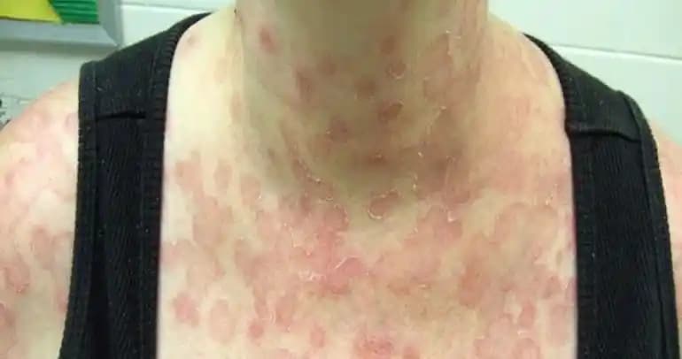 Sırtta Gül Hastalığı ve Kozmetik Bakımda Etkili Çözüm Yolları