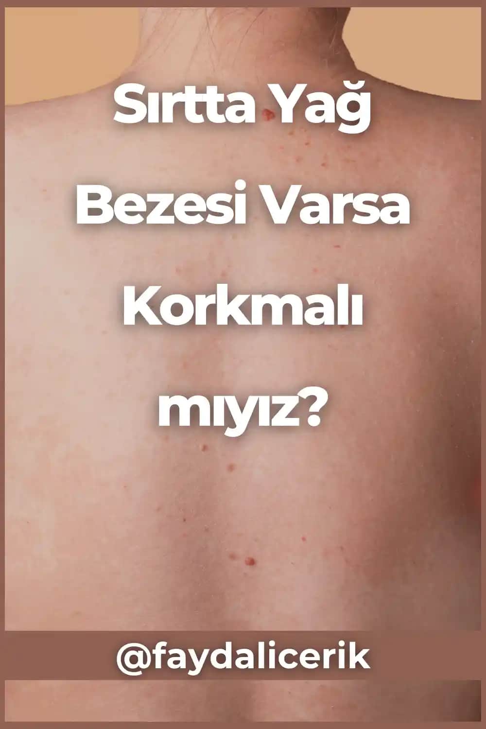 Sırtta Kızarıklık Nedenleri ve Çözüm Yolları Analizi