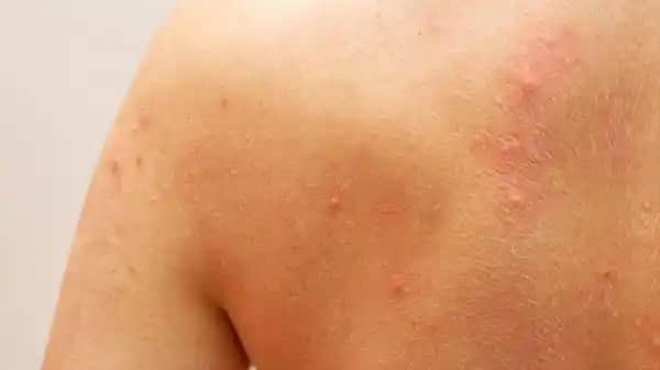 Sırtta Sivilce Nedenleri ve Etkili Önleme Yöntemleri Hakkında Detaylı Bilgi