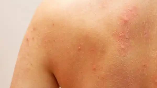 Sırtta Sivilce Nedenleri ve Etkili Önleme Yöntemleri Hakkında Detaylı Bilgi