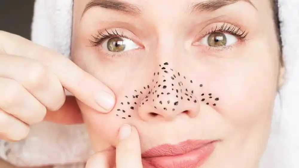 Sırtta Siyah Nokta Temizliği İçin Etkili Yöntemler ve Bakım İpuçları