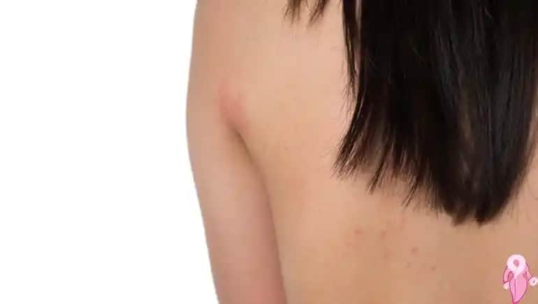 Sırttaki Lekelerin Nedenleri ve Etkili Çözüm Yolları Hakkında Kapsamlı Bilgi