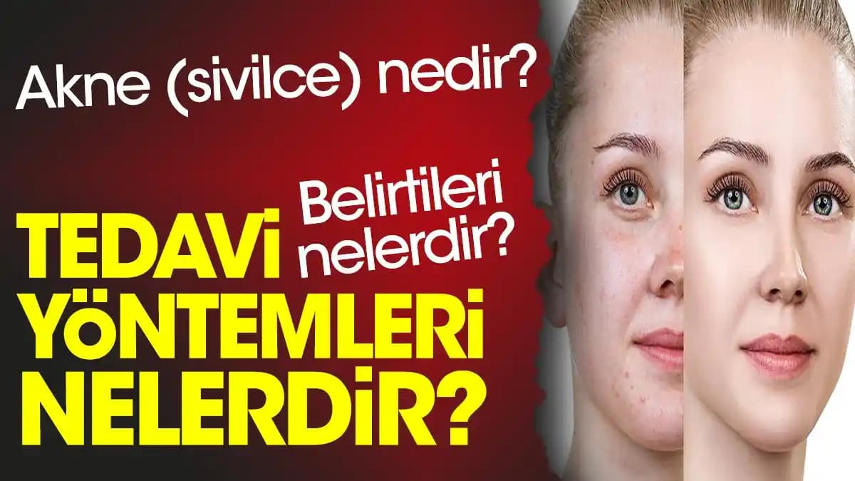 Sivilce Azaltma Yöntemleri ve Kozmetik Çözümler Hakkında Detaylı Bilgi