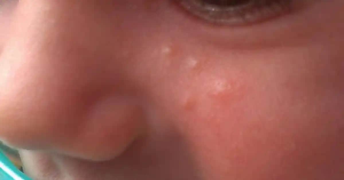 Sivilce Çözüm Yolları ve Sağlıklı Cilt İçin Etkili Bakım Tavsiyeleri