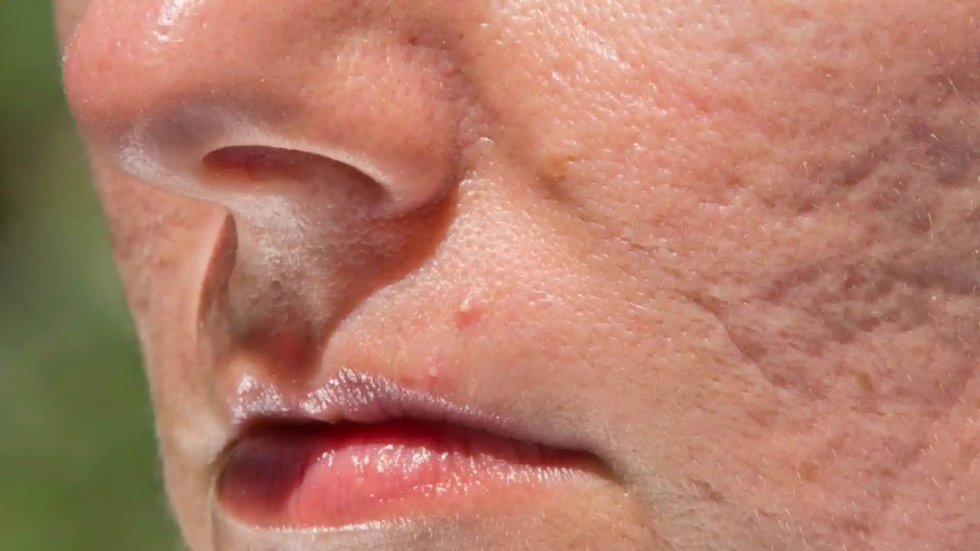 Sivilce Çukurları ve İzleri İçin Güncel Tedavi Yöntemleri ve Doğal Çözümler