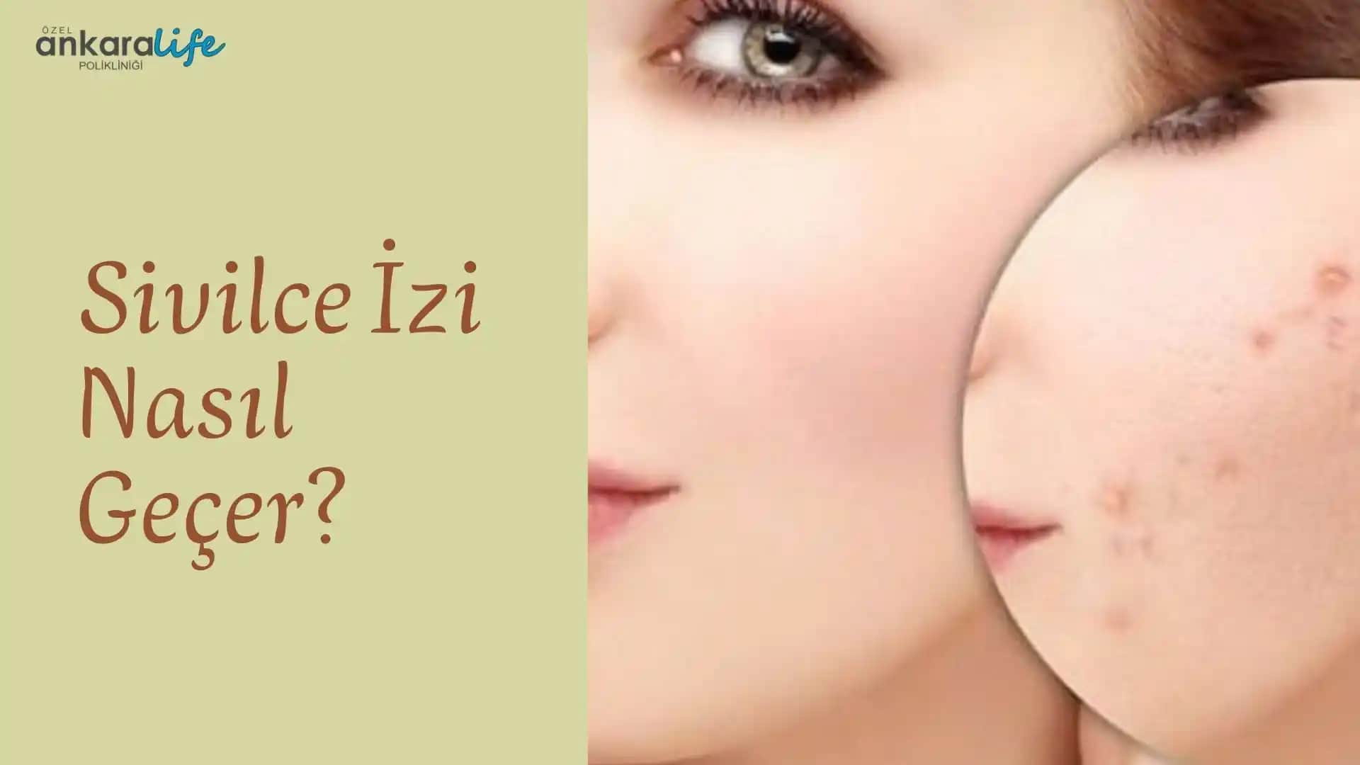 Sivilce İzi ve Kızarıklıkların Azaltılması İçin Etkili Yöntemler ve Uzman Tavsiyeleri