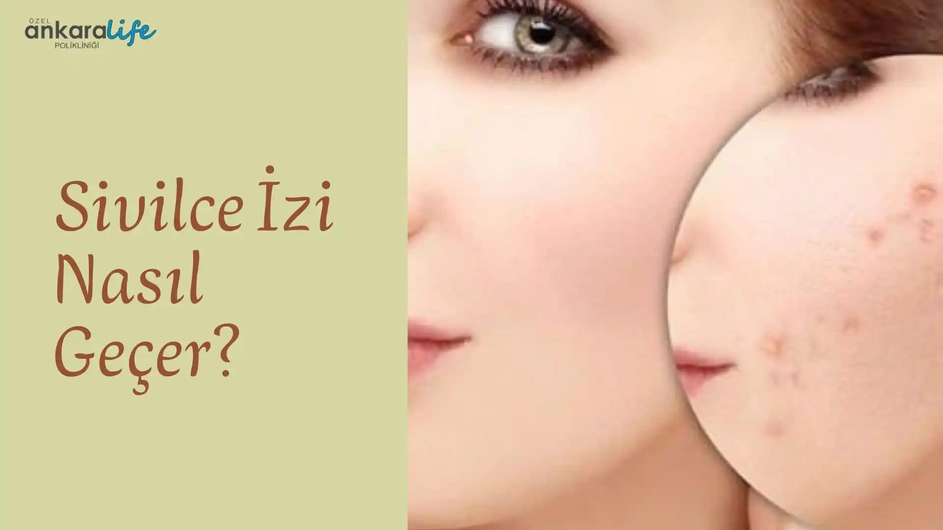 Sivilce İzi ve Kızarıklıkların Azaltılması İçin Etkili Yöntemler ve Uzman Tavsiyeleri