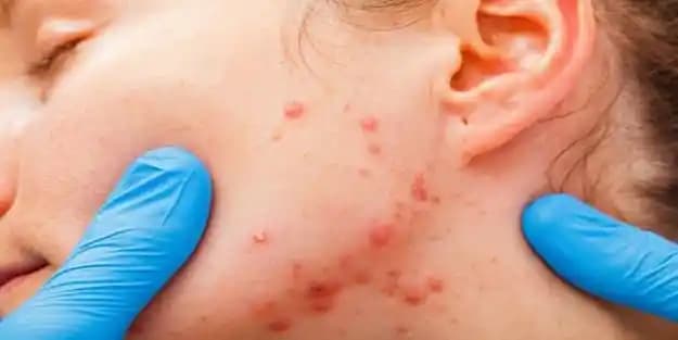 Sivilce İzleri Neden Oluşur ve Etkili Çözüm Yöntemleri Nelerdir