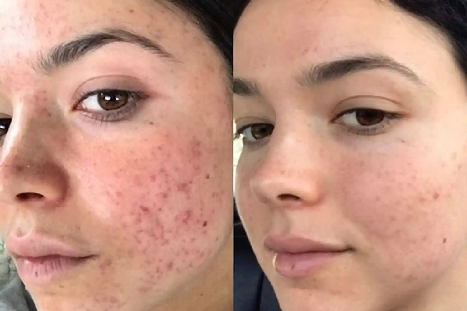 Sivilce İzleri ve Lazer Tedavisi: Kalıcı ve Güvenilir Çözümlerle Pürüzsüz Cilt