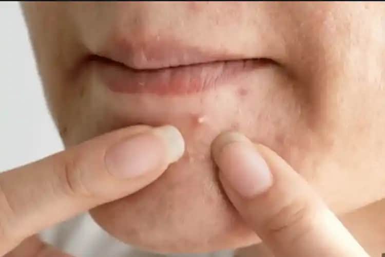 Sivilce İzlerine İyi Gelen Asitler ve Cilt Yenileme Yöntemleri Hakkında Bilgiler