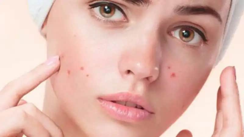 Sivilce Kaç Yaşında Geçer Cilt Sağlığı ve Akneyle Mücadele Yöntemleri