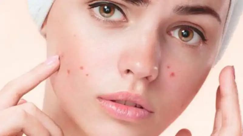 Sivilce Kaç Yaşında Geçer Cilt Sağlığı ve Akneyle Mücadele Yöntemleri