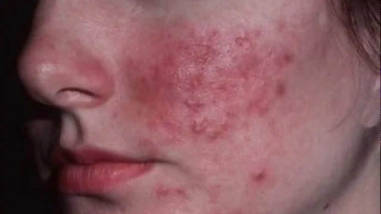 Sivilce Kızarıklığını Azaltan Etkili Yöntemler ve Cilt Sağlığı İpuçları