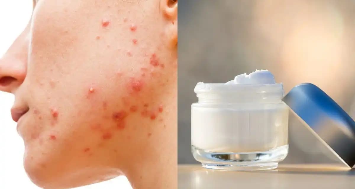 Sivilce Kremi Yanığı Nedenleri Belirtileri ve Etkili Çözüm Yolları Hakkında Detaylı Bilgi