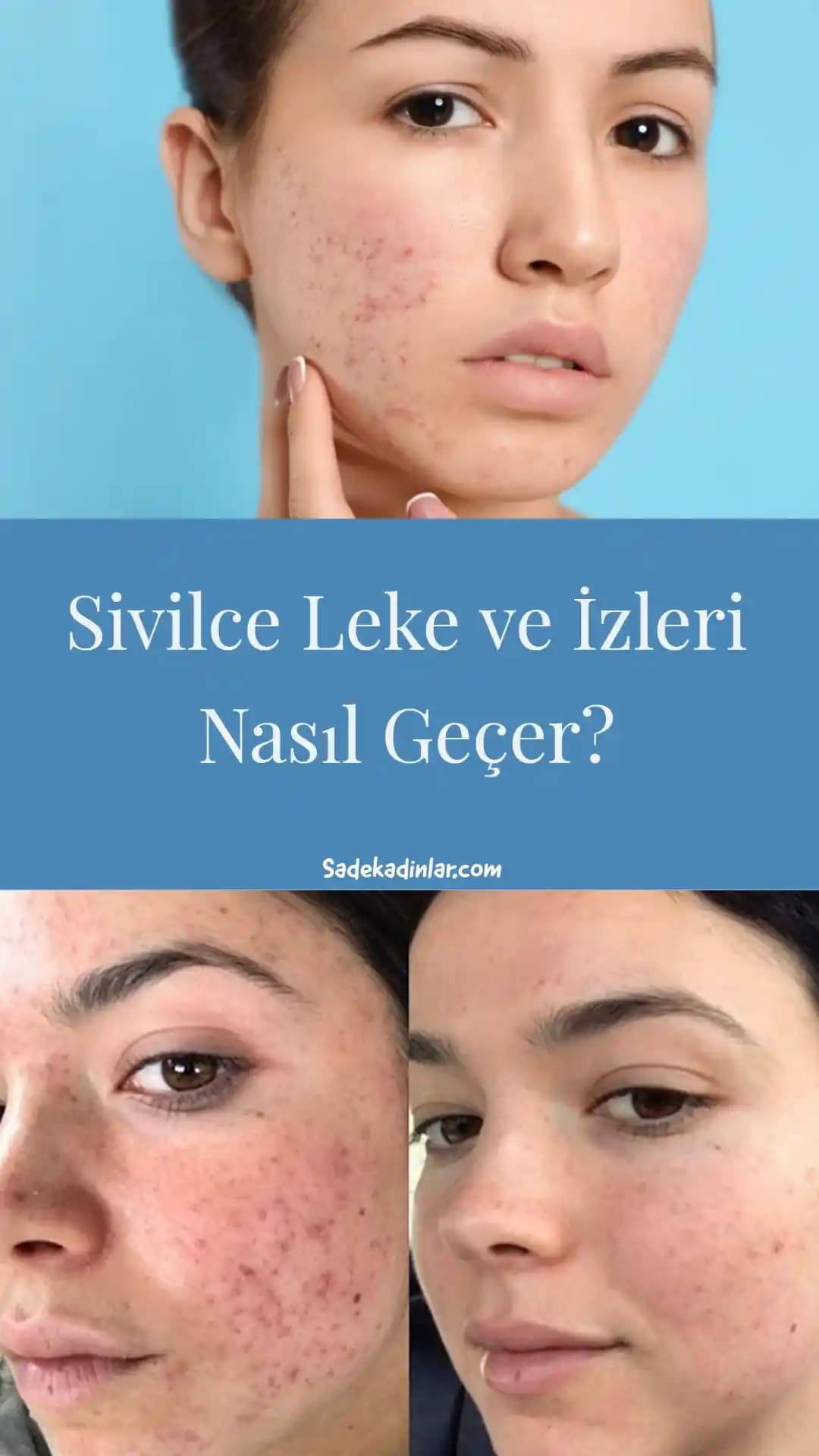 Sivilce Lekeleriyle Mücadelede En Güncel ve Etkili Yöntemler ve Cilt Bakım İpuçları
