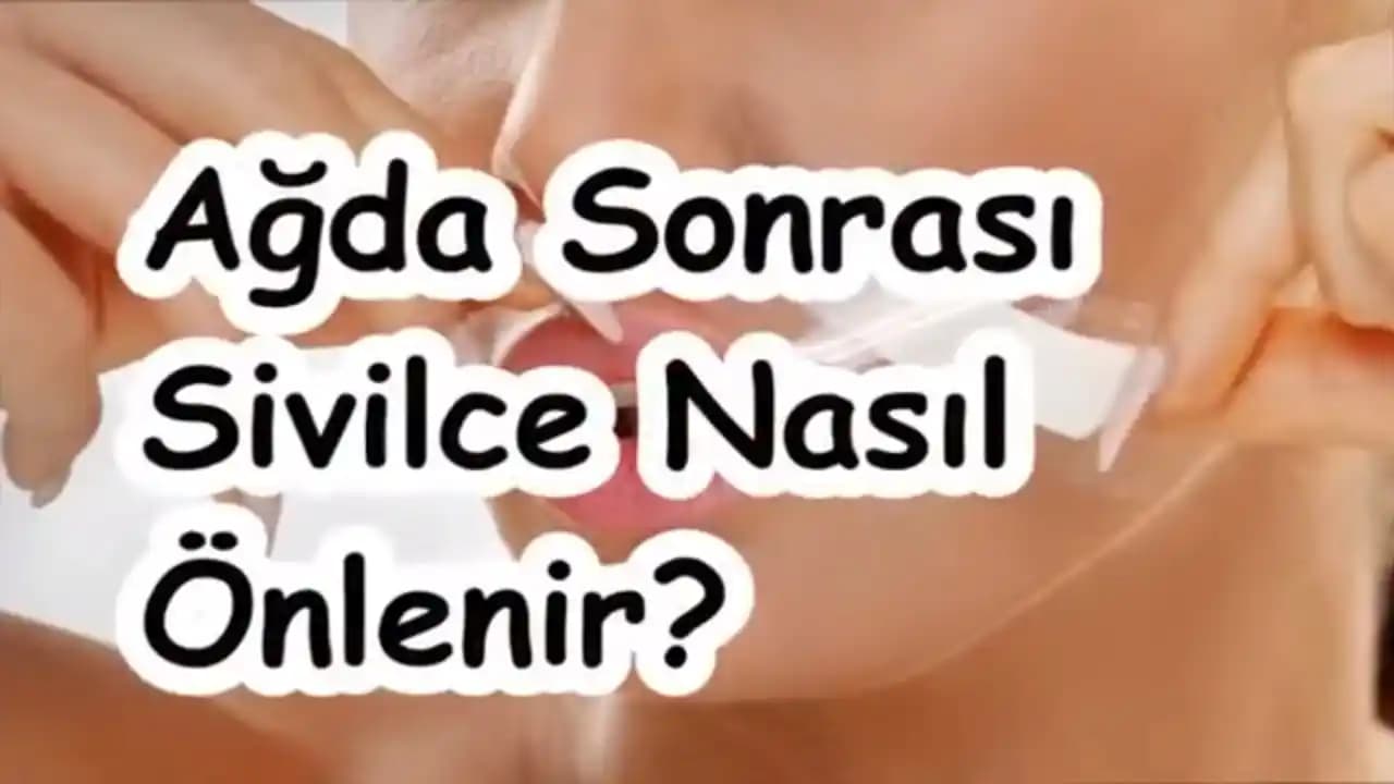 Sivilce Nasıl Önlenir ve Cilt Sağlığını Koruma Yöntemleri