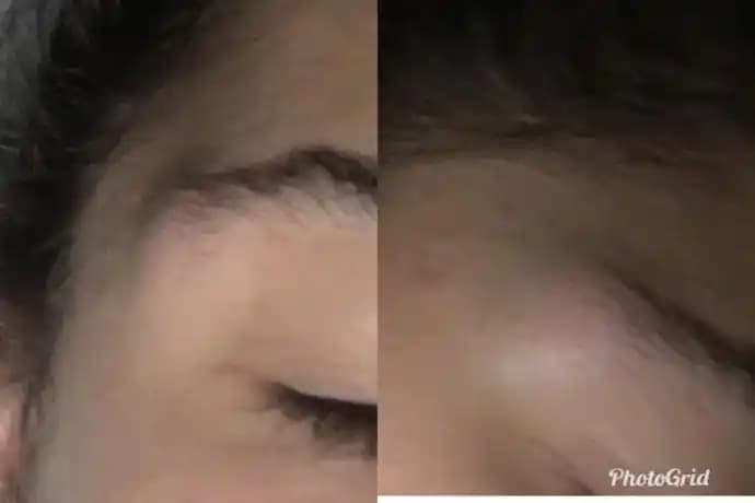 Sivilce Neden Şişer? Cilt Sağlığını Korumak İçin Bilmeniz Gerekenler