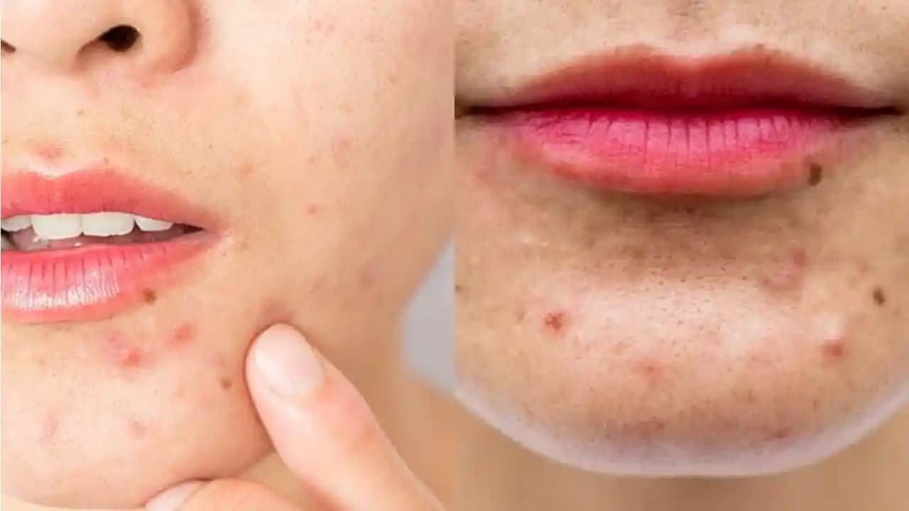 Sivilce Nedenleri ve Cilt Sağlığını Koruma Yöntemleri