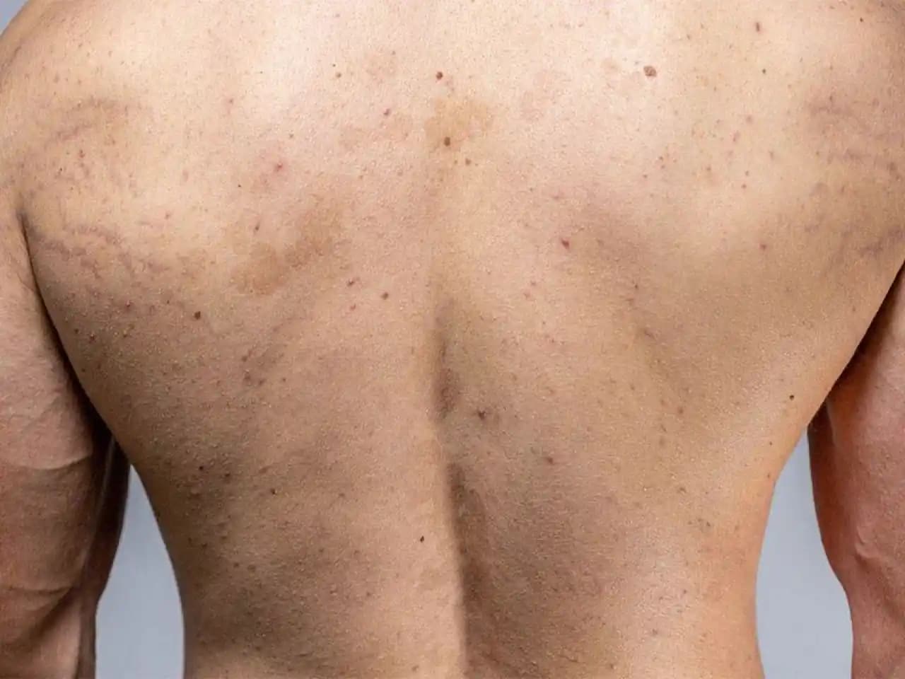 Sivilce Nedenleri ve Kalıcı Çözüm Yolları Hakkında Detaylı Rehber