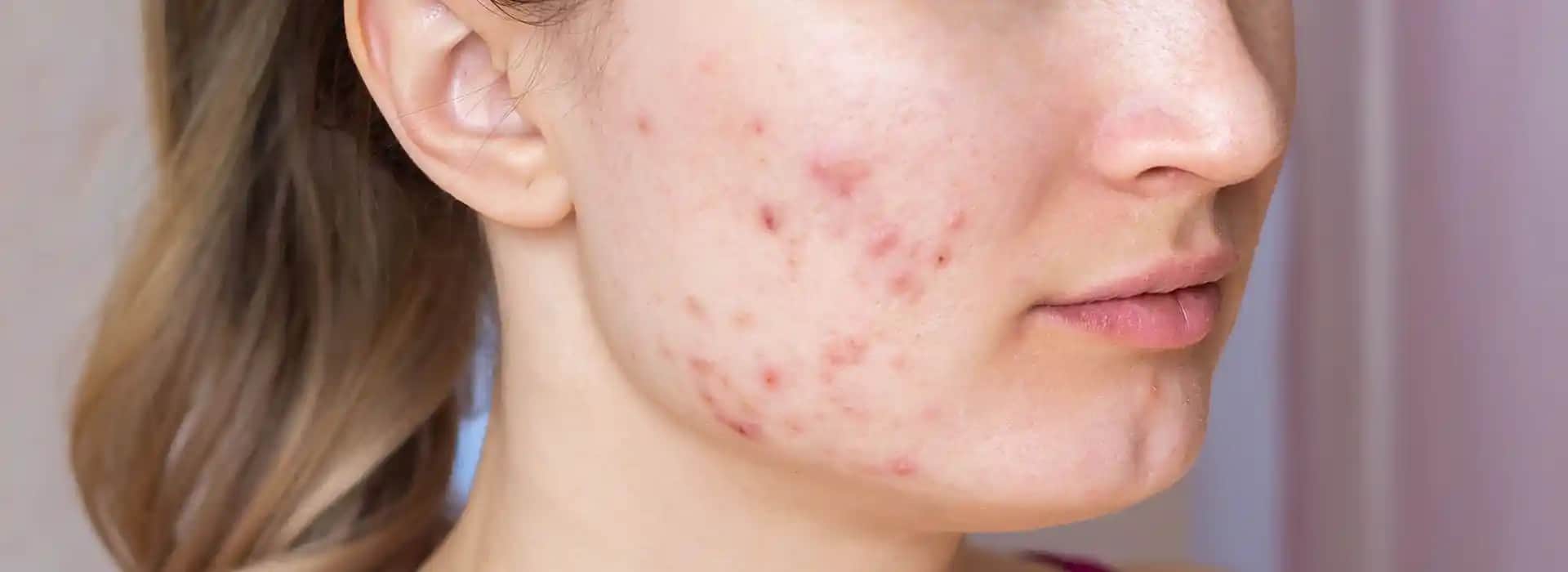 Sivilce Nedir? Cilt Sağlığı İçin Bilmeniz Gerekenler ve Etkili Bakım Yöntemleri