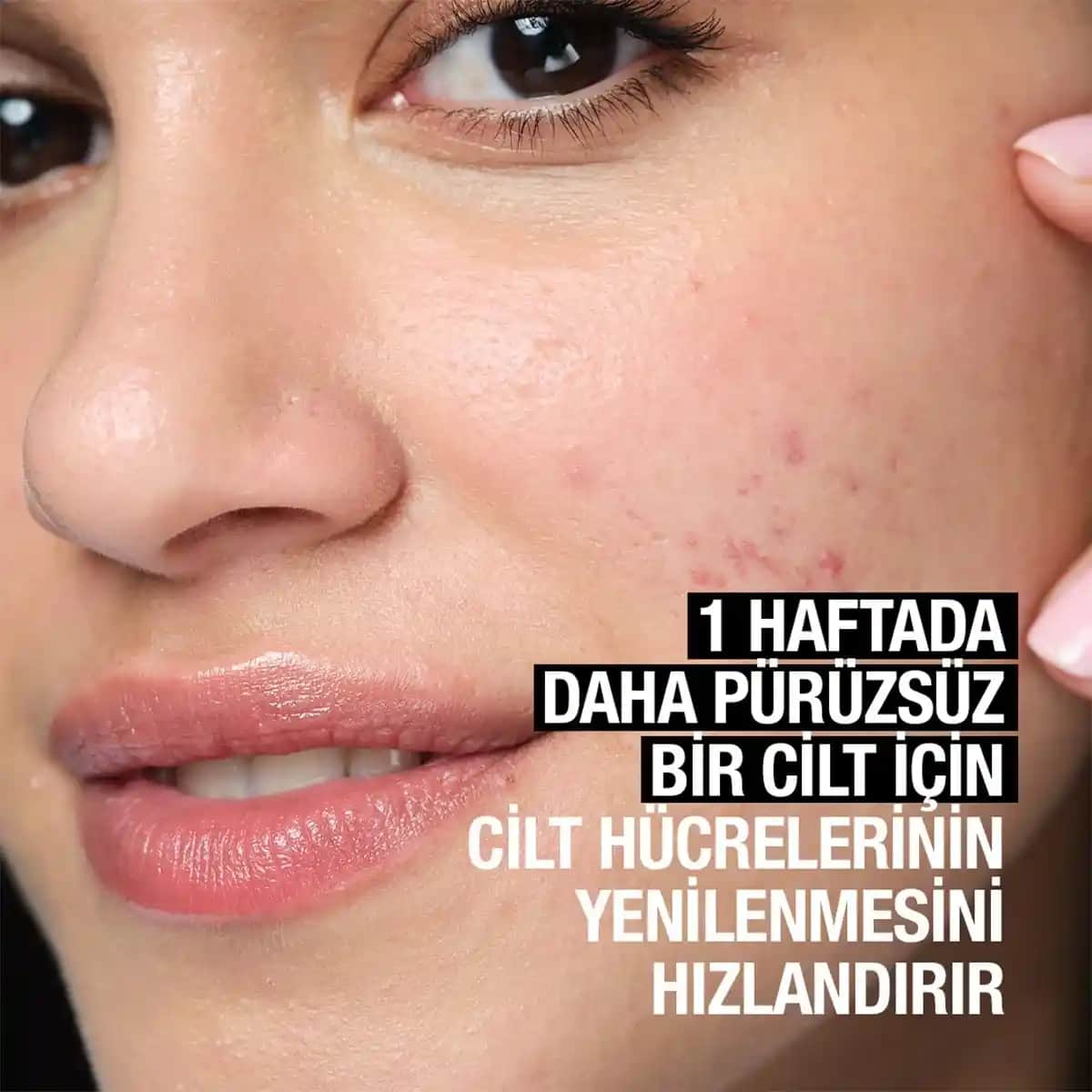 Sivilce Peelingi Nedir, Nasıl Uygulanır ve Cilt Sağlığına Faydaları Nelerdir