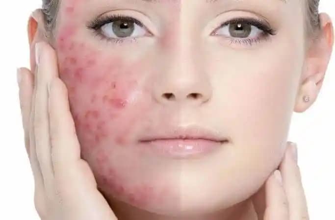 Sivilce Temizleme Yöntemleri ve Cilt Bakımı İpuçları