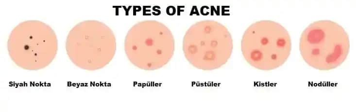 Sivilce Türleri ve Cilt Sağlığı İçin Doğru Bilgi Rehberi