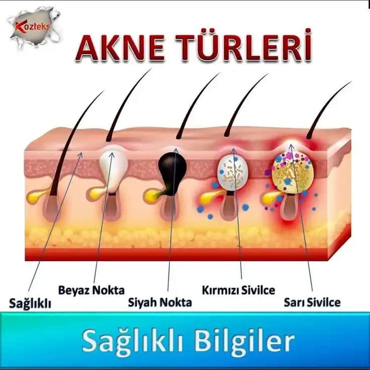 Sivilce Türleri ve Özellikleri Hakkında Detaylı Bilgi ve Bakım Yöntemleri