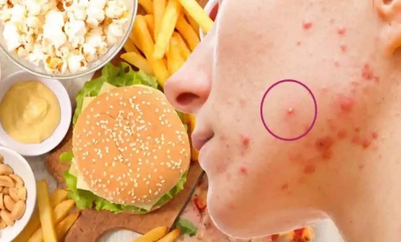 Sivilce ve Akneye Neden Olan Yiyecekler ile Cilt Sağlığını Koruma Yöntemleri