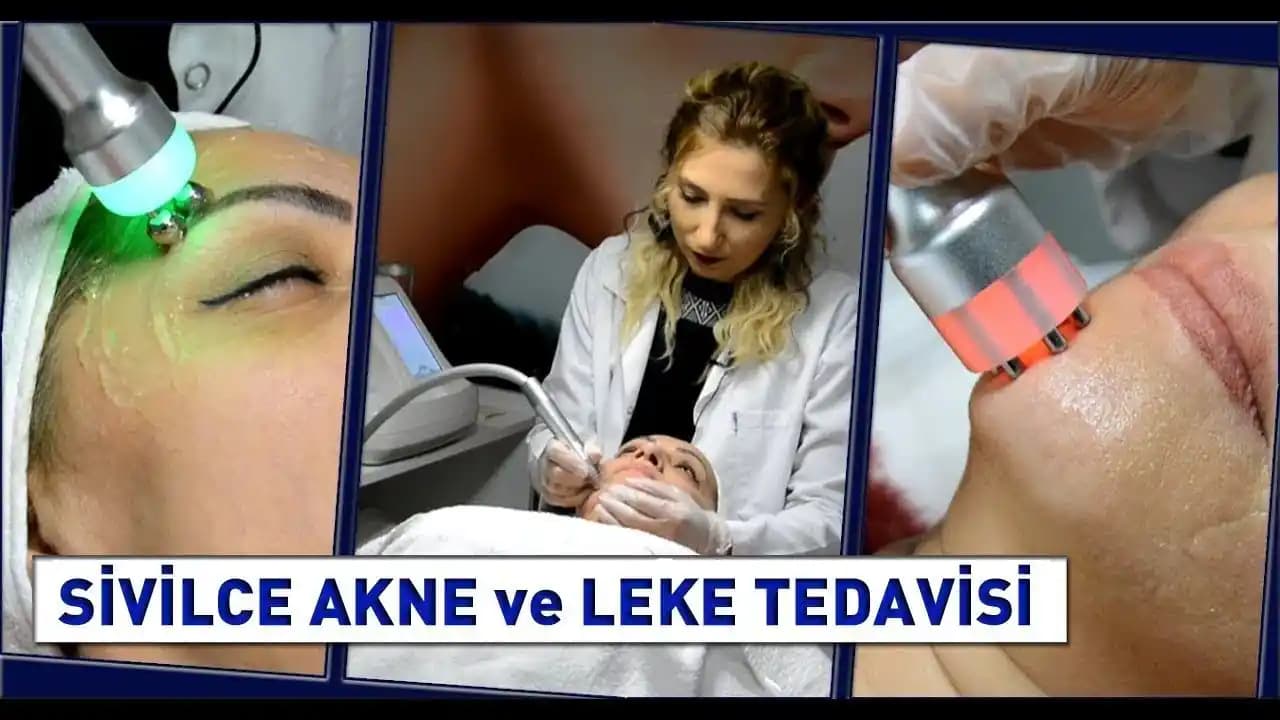 Sivilce ve Leke Tedavisi Yöntemleri: Modern ve Doğal Yaklaşımlar ile Cilt Sağlığını Koruma