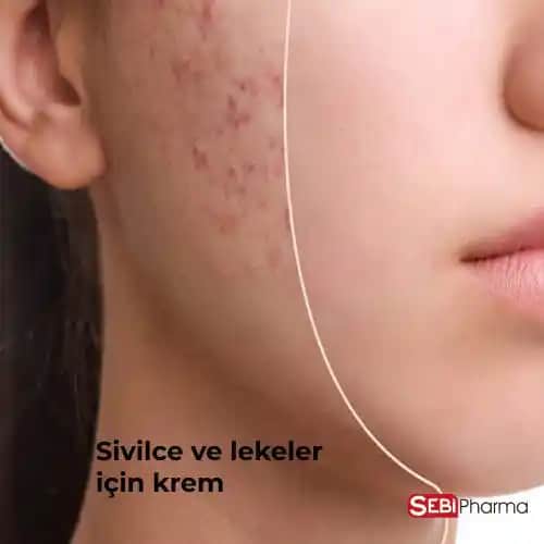 Sivilce ve Lekeler İçin Etkili Kozmetik Yaklaşımlar ve Cilt Sağlığı İpuçları