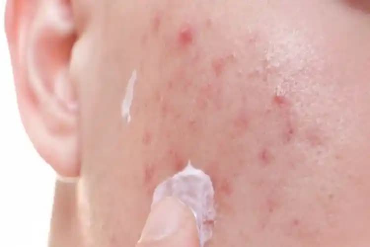 Sivilce Yaralarına Doğru Bakım ve Tedavi Yöntemleri Cilt Sağlığını Destekler